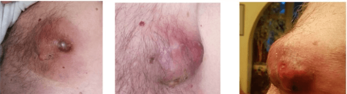 राजस्थान में पुरुषों में भी बढ़ रहा ब्रेस्ट कैंसर, हर साल 250–300 केस, 60% तीसरी-चौथी स्टेज में