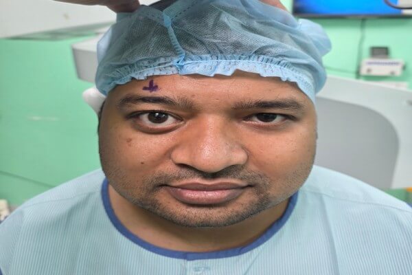 मैक्स पंचशील पार्क के डॉक्टर्स ने किया चमत्कारिक ऑपरेशन: अंगूर आकार का आइ सॉकेट ट्यूमर हटाकर मरीज की आंखों की रोशनी बचाई